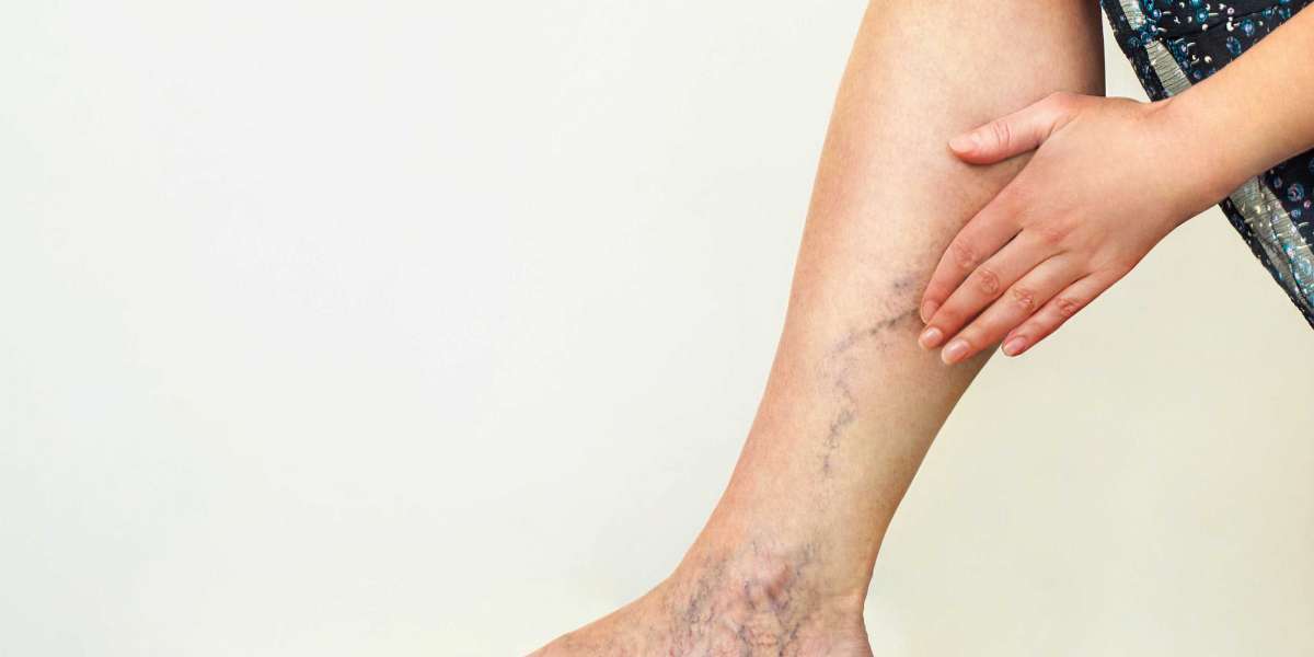 When should I see a vein specialist?