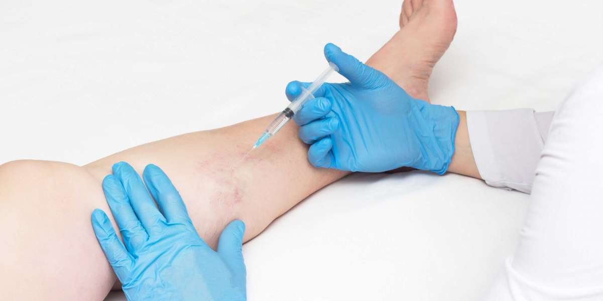 How to Effectively Prepare for Varicose Vein and Spider Vein Treatment?