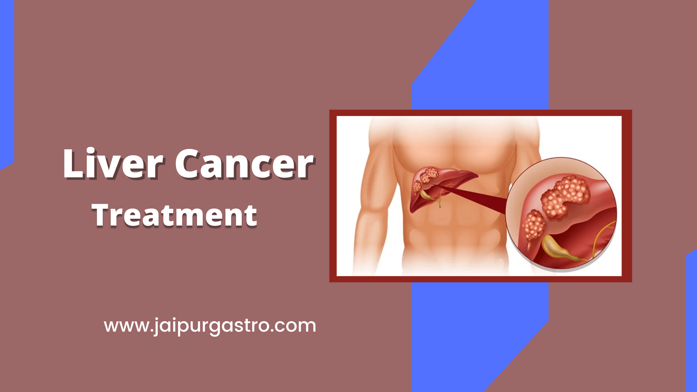 Liver Cancer Treatment In Jaipur By Dr. Shankar Dhaka | Jaipur Gastro