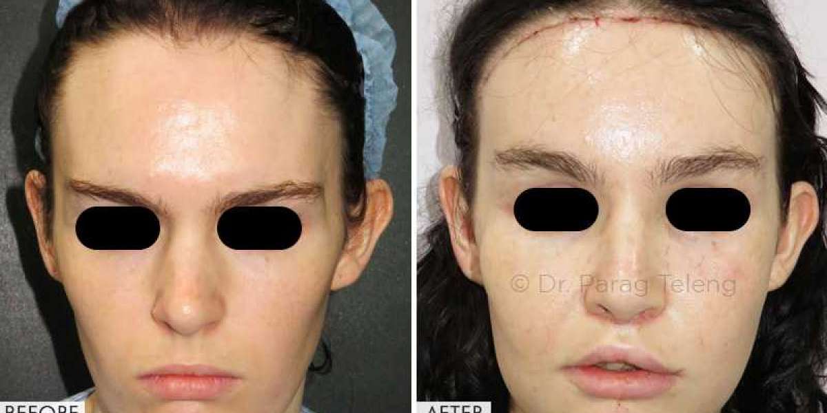 Cost of Facial Feminization Surgery India, USA