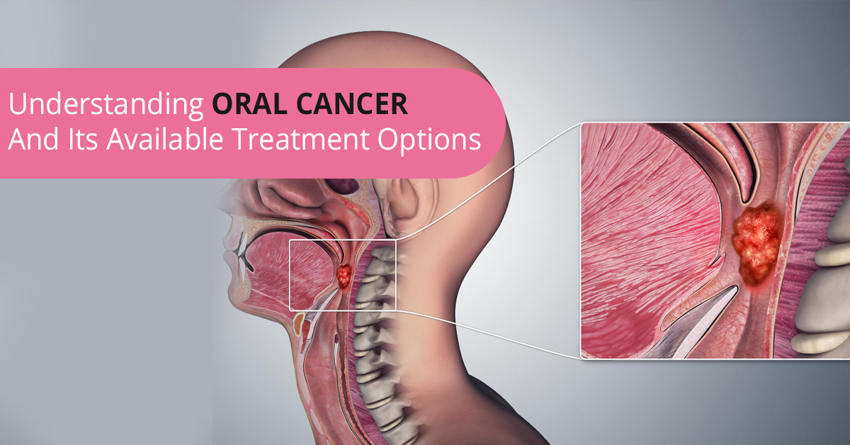 Oral Cancer Available Treatment - University Cancer Treatment