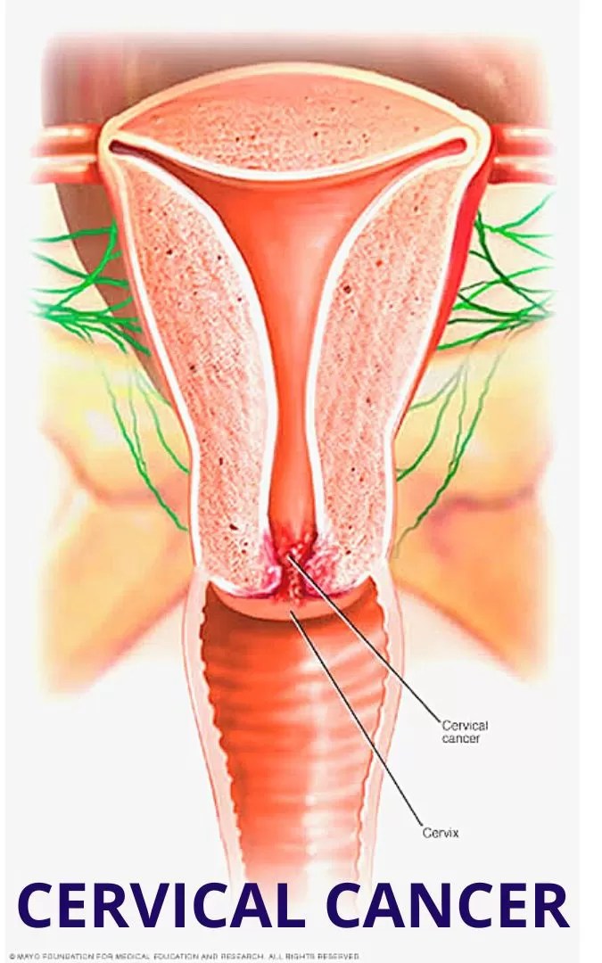 Cervical Cancer - Causes, symptoms and Treatment – Dailynaijanews24