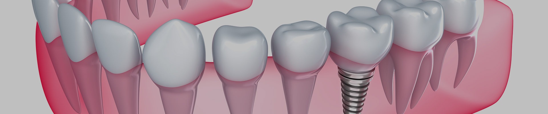 Dental Implants NE Calgary | Restorative Dentist | Redstone Smiles Dental