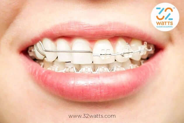 Do Braces Have Side Effects? | Disadvantages Of Wearing Teeth Braces