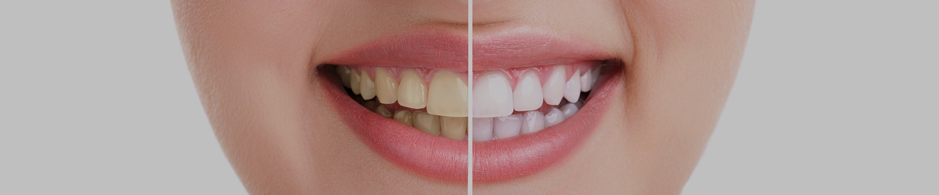 Cosmetic Dentistry NE Calgary | Redstone Smiles Dental