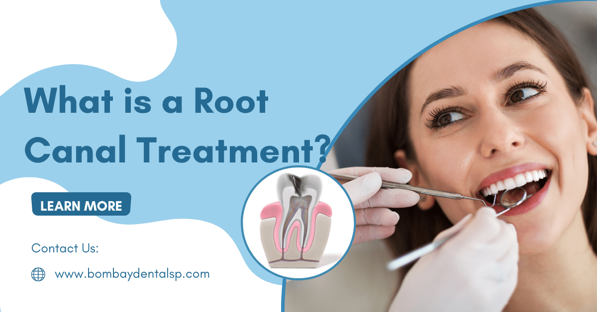   What is a Root Canal Treatment? 