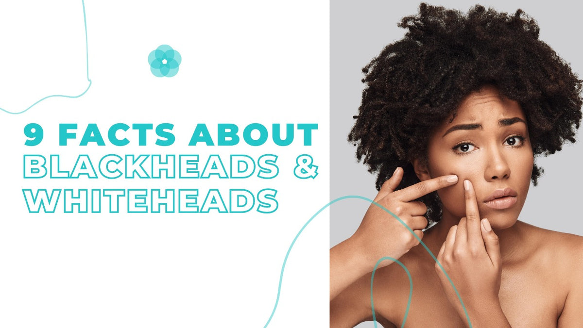Facts About Blackheads & Whiteheads