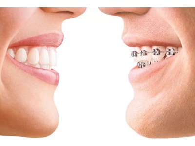 What Are the Types of Orthodontic Treatments Available For Adults? | TechPlanet