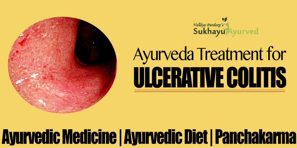 Ayurveda treatment for ulcerative colitis