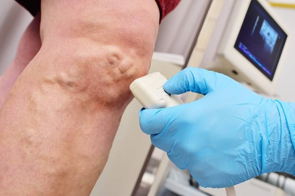 7 Signs That It's Time To See A Vein Specialist - Wellness - OtherArticles.com