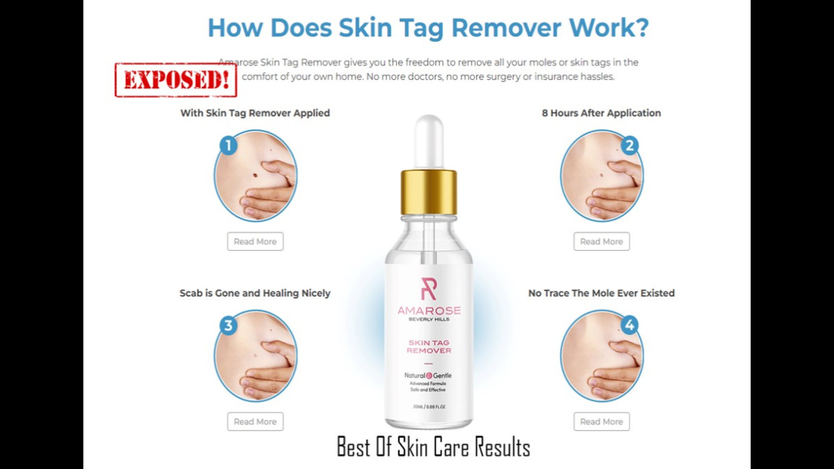 Amarose Skin Tag Remover | Best Skin Tag Remover | Mole Removal Serum Exposed! Is It Scam Or Work?