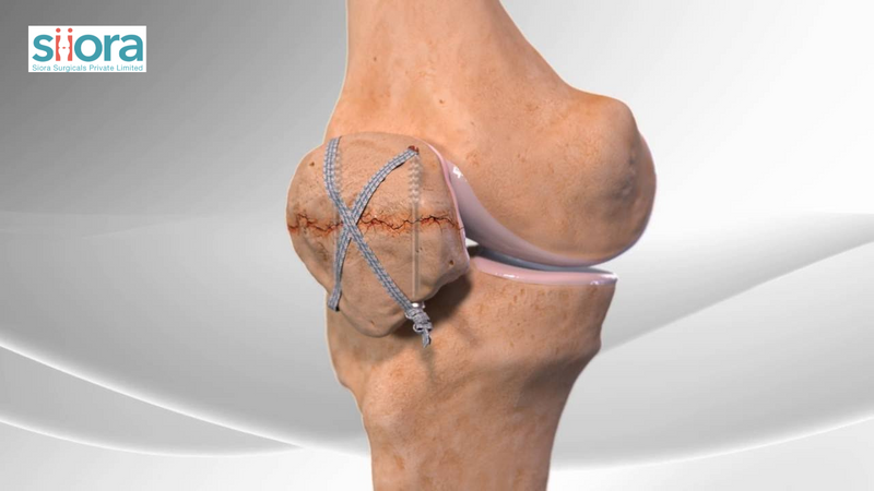 A Quick Guide to Patellofemoral Joint - Orthopedic implants