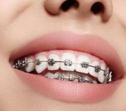 Dental Braces Treatment Clinic in Rajasthan, Cheap Dental Braces Services India