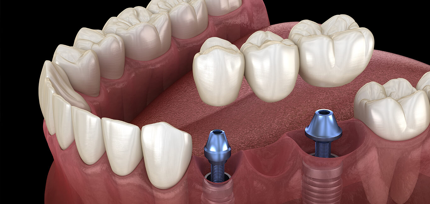 Best Dental Implants Clinic in New Delhi - The Dental Roots
