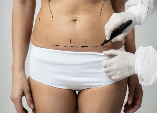 Things you Need to Know Before Going for Liposuction Surgery