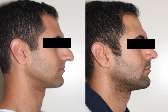 Rhinoplasty Surgery in Delhi to Intensify Your Facial Look | by Dr. Ashish Khare