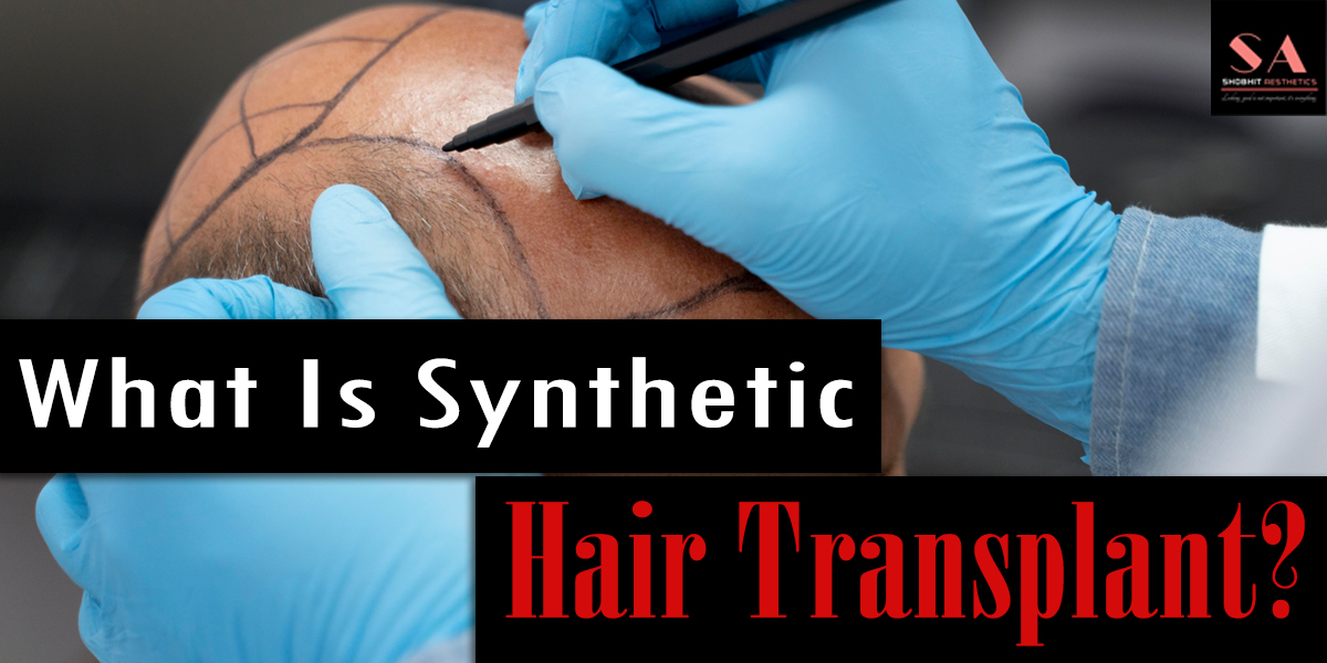 What Is Synthetic Hair Transplant? Significance of Synthetic