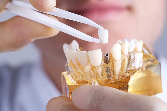 Dental Implants Surgery Houston TX | Prestige Periodontal