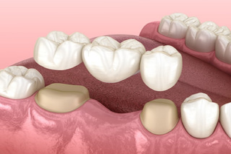 Dental Tooth Crown & Bridge Treatment in Robstown, TX | RS