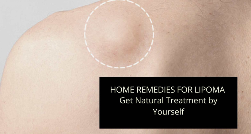 Home Remedies for Lipoma - Get Natural Treatment by Yourself