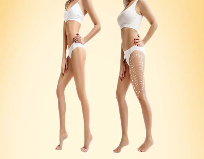 Unlock Your Confidence: Why Tummy Tuck in Dubai is the Perfect Choice for You! | Lifehack