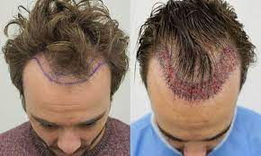 Will My Hair Transplant Be Permanent?