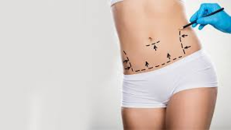 10 Reasons to Try Tummy Tuck in Dubai | Times Square Reporter