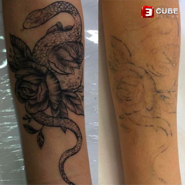 Tattoo removal in Kolkata | laser Tattoo removal Studio | 3 Cube Tattoo