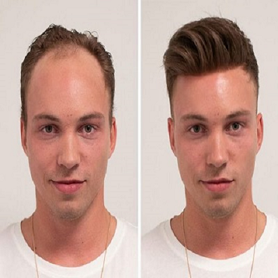 DYNAMIC AESTHETIC CLINIC IN DUBAI : Hair Transplant in Dubai