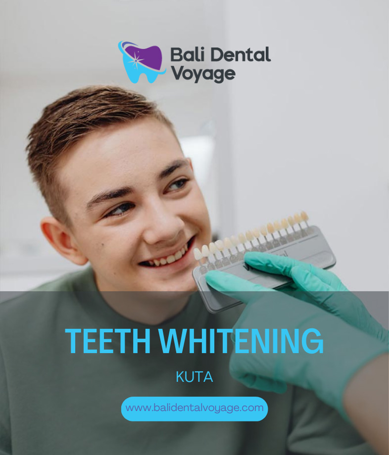 Teeth Whitening Kuta - Teeth Whitening Kuta Bali