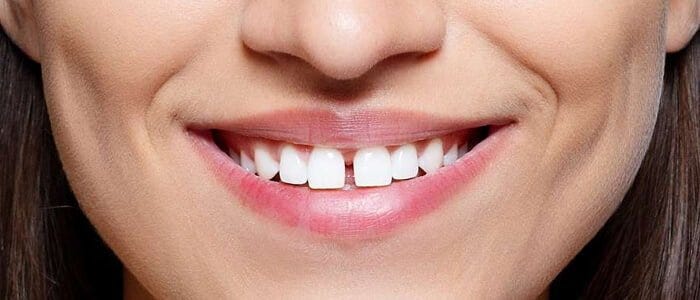 Exploring Dental Bridges: A Solution for a Seamless Smile | by Dr. Michael Sohl Implant & Cosmetic Dentistry | Aug, 2023 | Medium