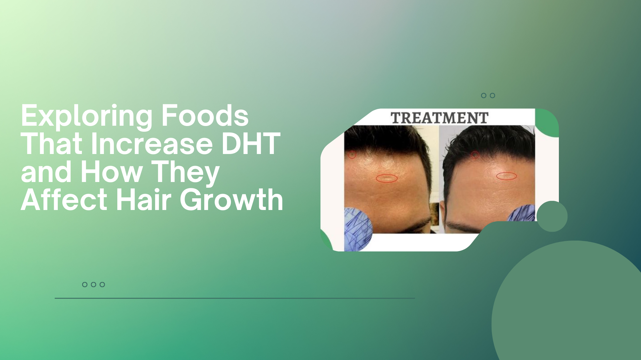 Exploring Foods That Increase DHT and How They Affect Hair Growth | Zupyak
