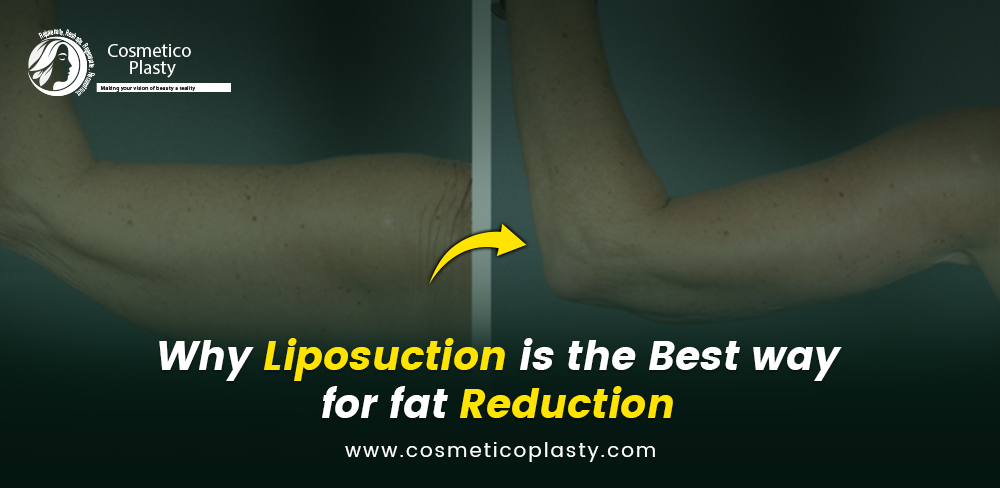 Why Liposuction Is The Best Way For Fat Reduction?