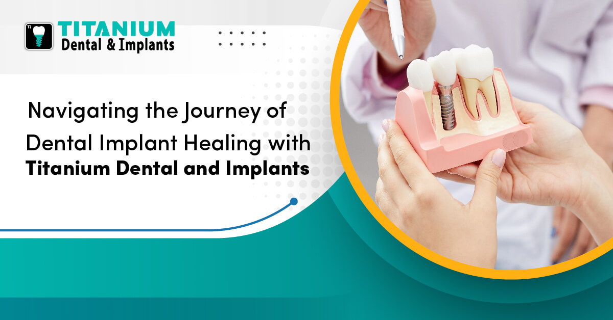 Navigating the Journey of Dental Implant Healing with Titanium Dental and Implants