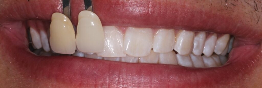 Teeth Whitening Sydney | Teeth Whitening Fairfield, Gregory Hills