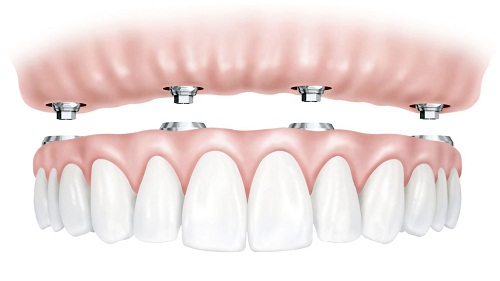 Full-Arch Restoration with Minimal Implants With All-on-4 Dental Implants - WriteUpCafe.com