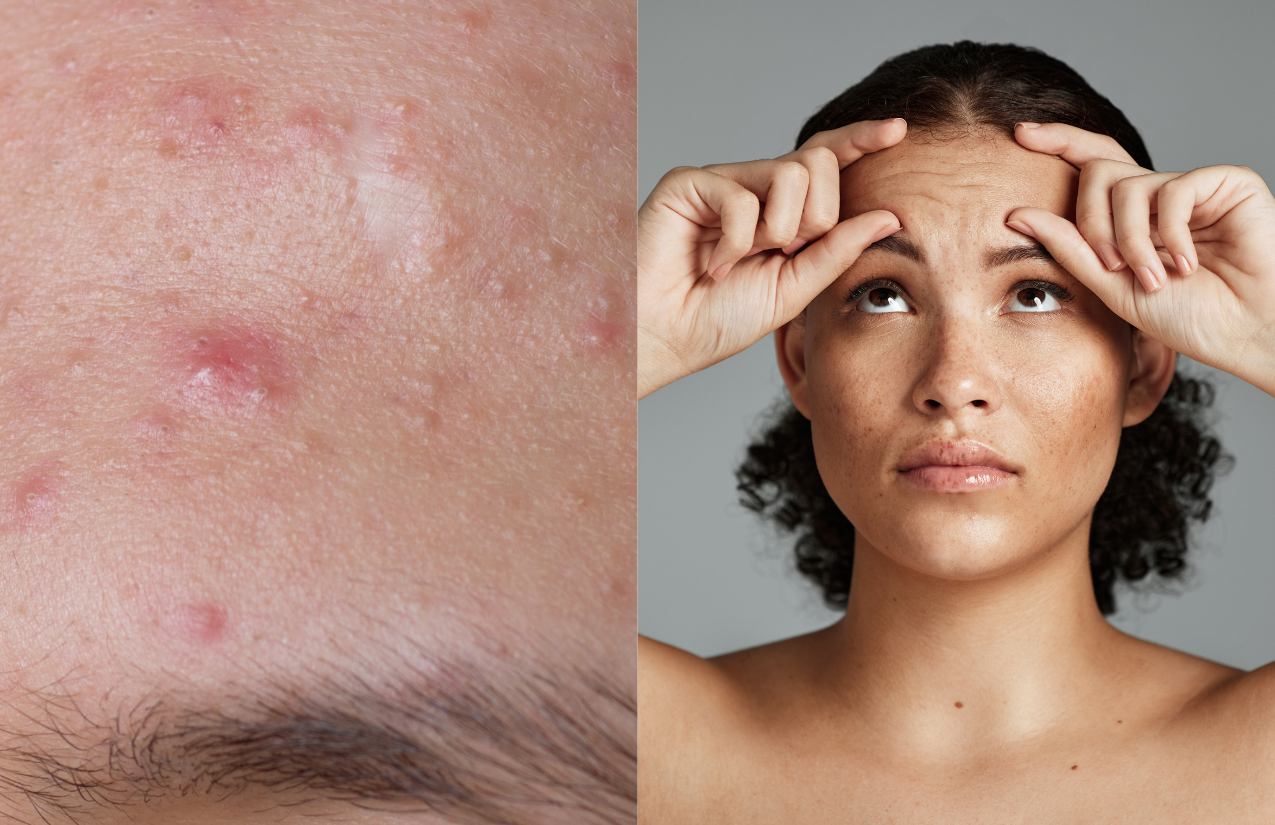 What Causes Acne on Forehead - Forever Acne Free