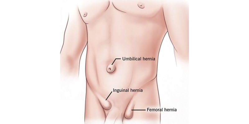 Looking for Inguinal Hernia Surgery?