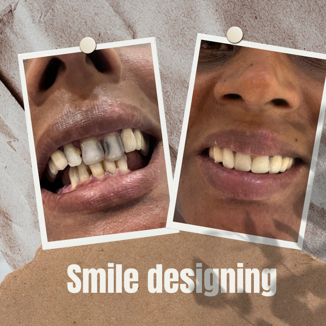 Crafting Radiant Smiles with Full Mouth Fixed Bridge and Smile Designing Treatment: edensdental — LiveJournal