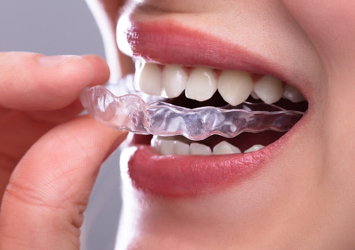 Advantages of Invisalign over Traditional Braces | by Aims Dentistry | Medium