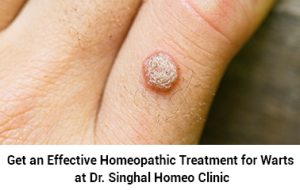 Get the Best Homeopathic Treatment for Warts Now!