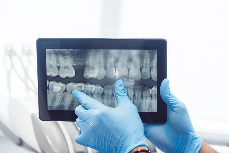 How Do Digital X-Rays Enhance Dental Treatment Planning?