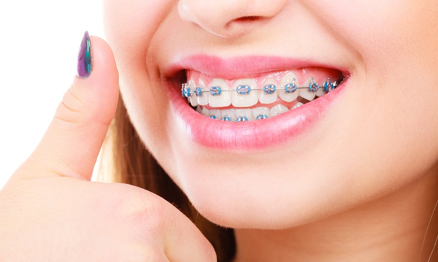 Unveiling The Health Benefits of Dental Braces