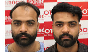 Factors which Determine the Price of Hair Transplant in Delhi
