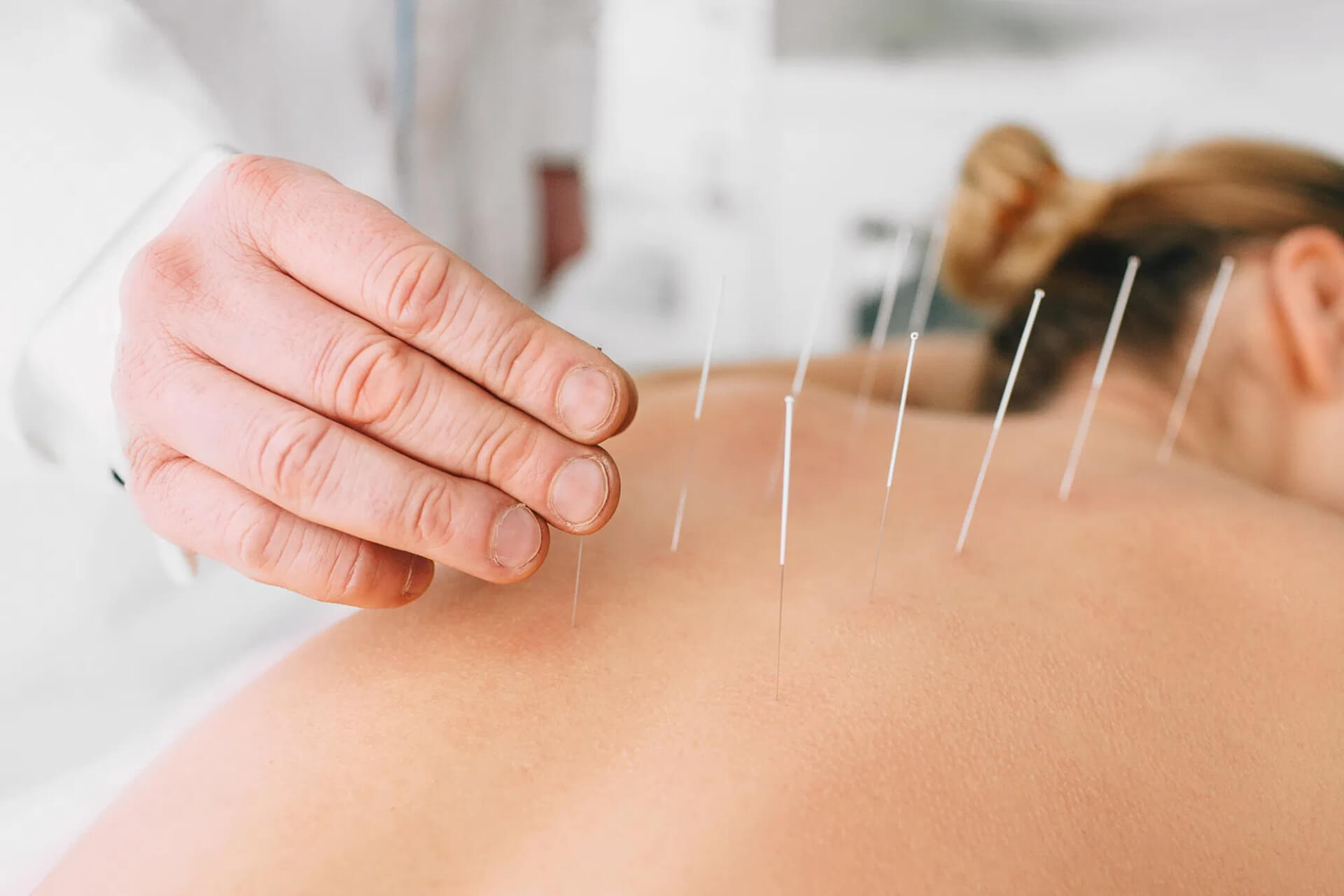 Acupuncture Treatment Charters Towers | Dry Needling in Richmond Hill