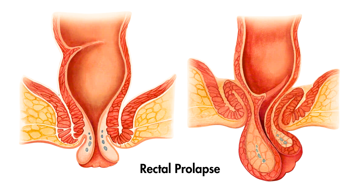 Rectal Prolapse: Symptoms, Causes and Treatment | Dr. Avadh Patel