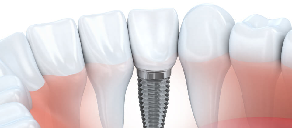 Wayne Implant Dentistry