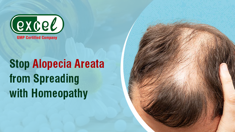 How Homeopathy Helps Treat Alopecia Areata?
