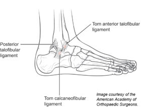 Foot & Ankle Muscle Strain | Genesis Orthopedics & Sports Medicine