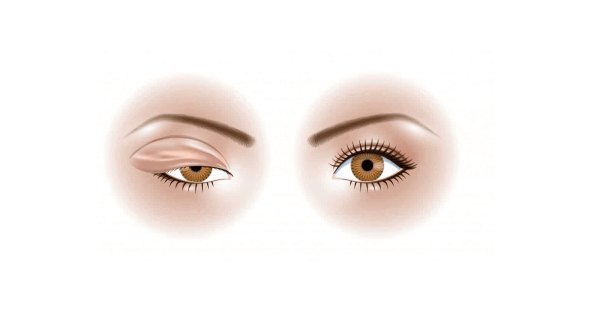 10 Eye-Opening Facts About Blepharoplasty
